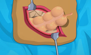 Operate Now: Cirurgia no Apêndice 